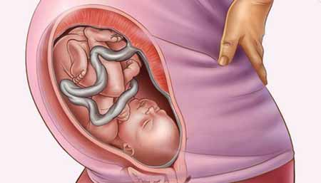 6 نا‌هنجاری‌ رحمی و تاثیر آن در بارداری