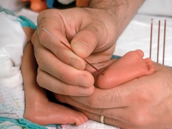 آزمایش خون از کف پای نوزاد