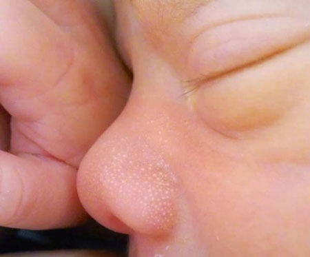جوش‌های ریز صورت و بدن نوزاد خطرناکه؟