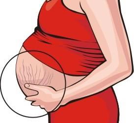 چگونه ترک های بارداری را از بین ببریم