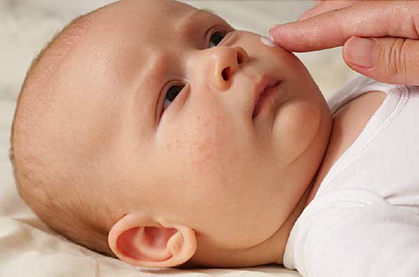 اگزمای پوستی نوزاد به خاطر چیه؟