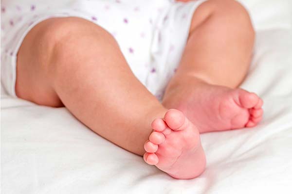 راه تشخیص پاهای پرانتزی نوزاد