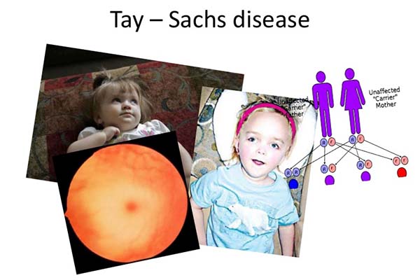 بیماری تای ساکس در نوزادان