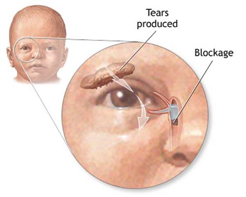 قی کردن چشم نوزاد